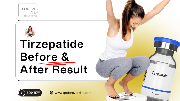 Tirzepatide– Before & After Results